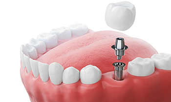 インプラント治療